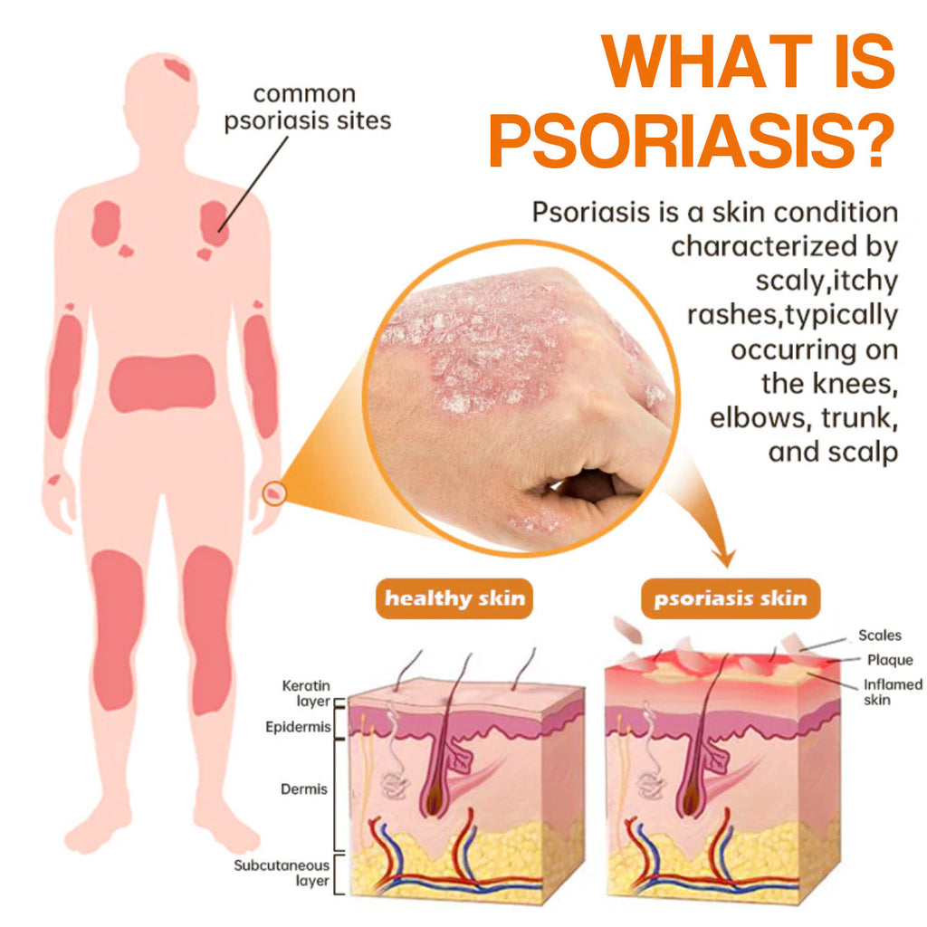 🔥رذاذ PsoriaHeal لعلاج الصدفية (خصم 60% على شراء الحزمة حتى اليوم الأخير فقط 🔥)