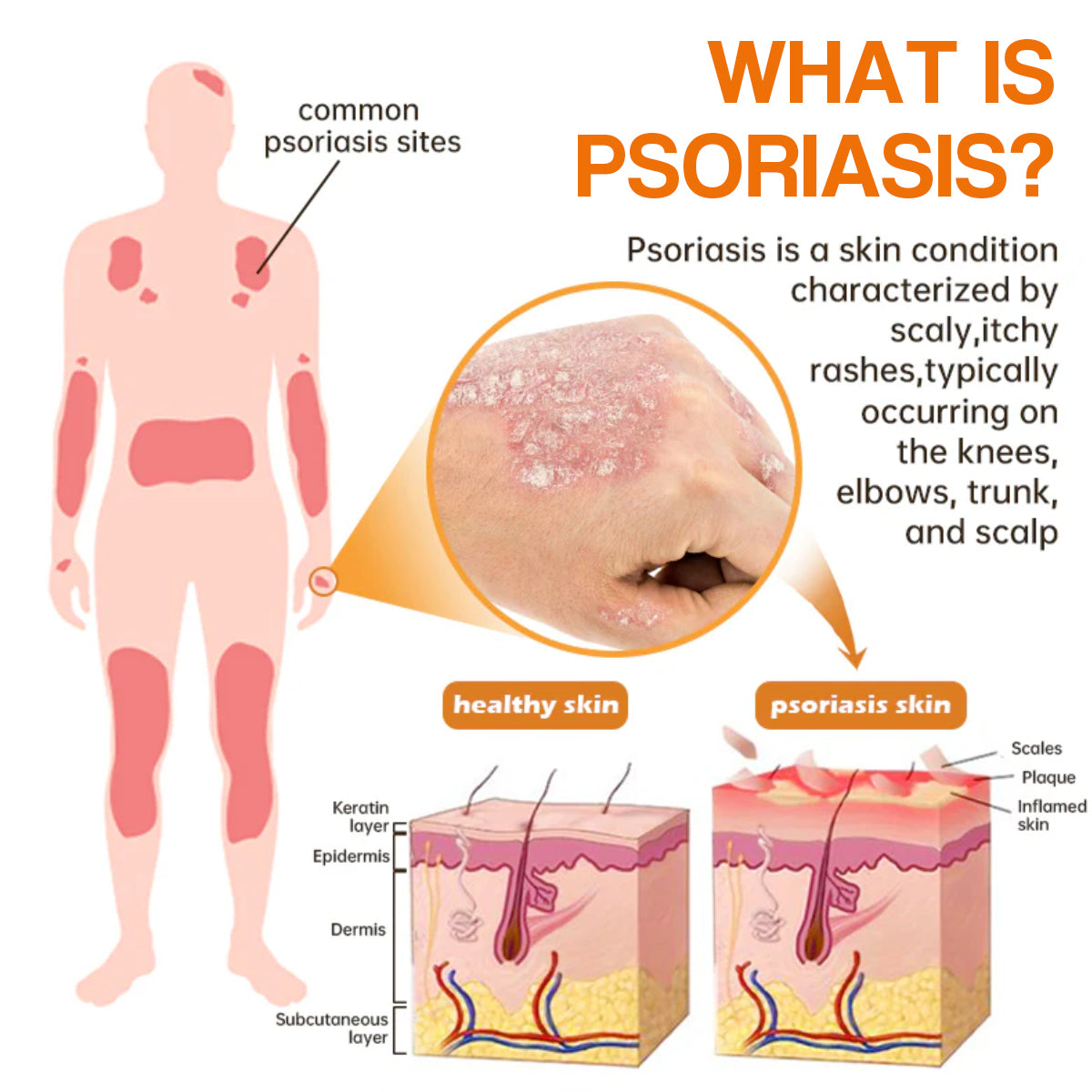 🔥رذاذ PsoriaHeal لعلاج الصدفية (خصم 60% على شراء الحزمة حتى اليوم الأخير فقط 🔥)