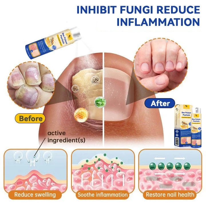🔥رذاذ PsoriaHeal لعلاج الصدفية (خصم 60% على شراء الحزمة حتى اليوم الأخير فقط 🔥)