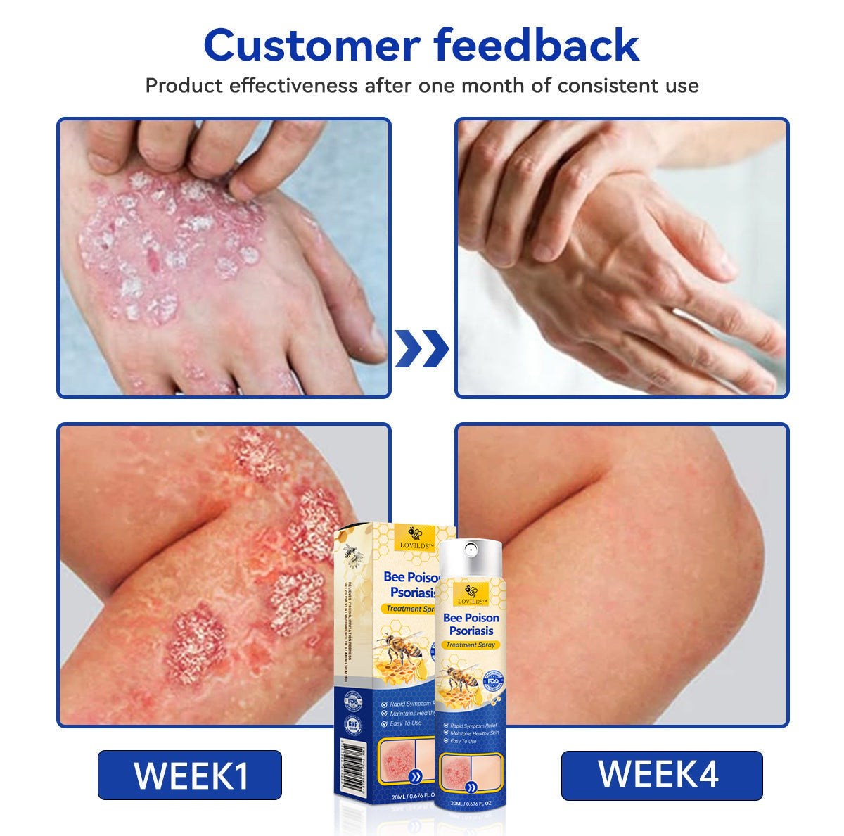 🔥رذاذ PsoriaHeal لعلاج الصدفية (خصم 60% على شراء الحزمة حتى اليوم الأخير فقط 🔥)