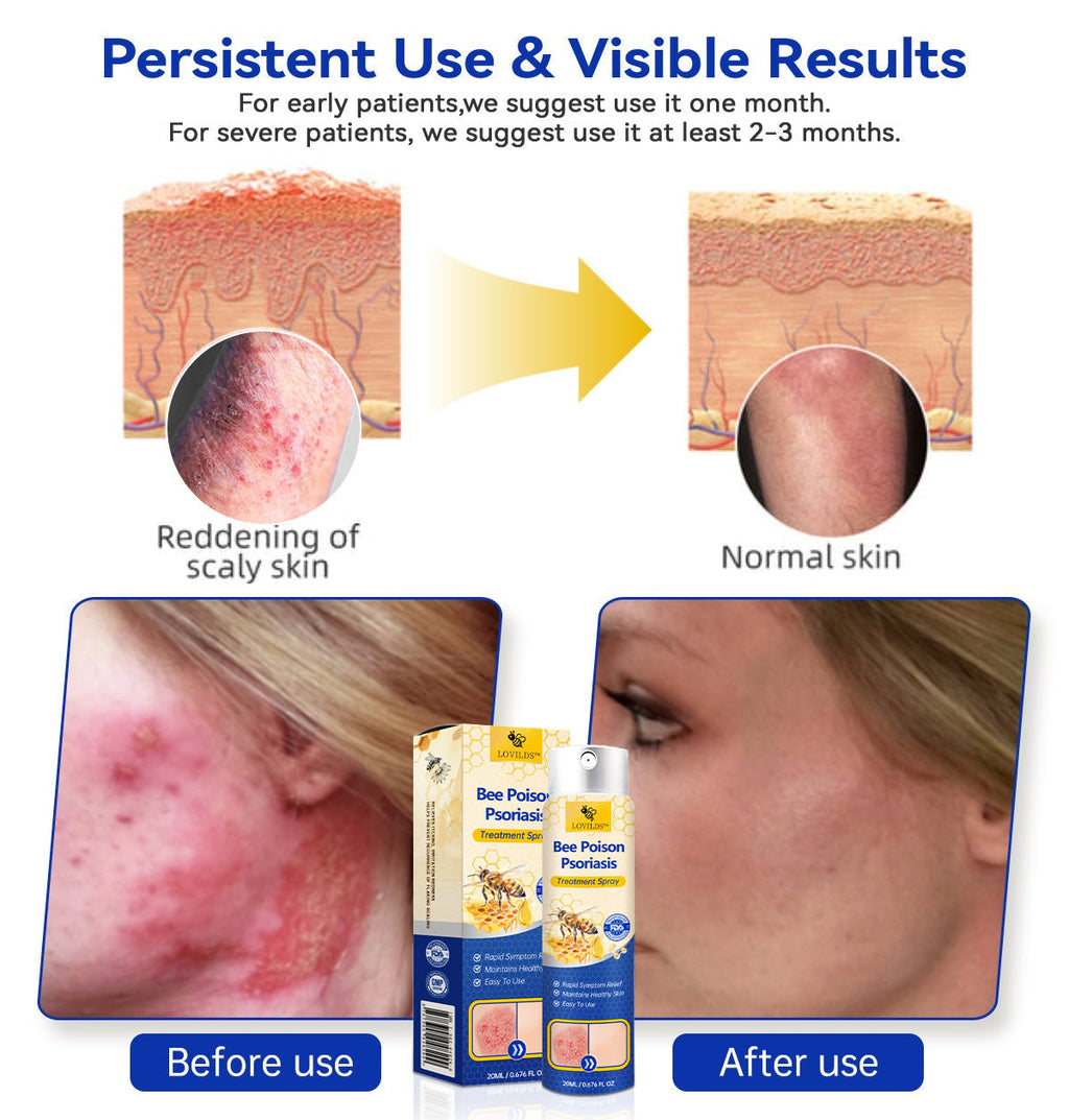 🔥رذاذ PsoriaHeal لعلاج الصدفية (خصم 60% على شراء الحزمة حتى اليوم الأخير فقط 🔥)