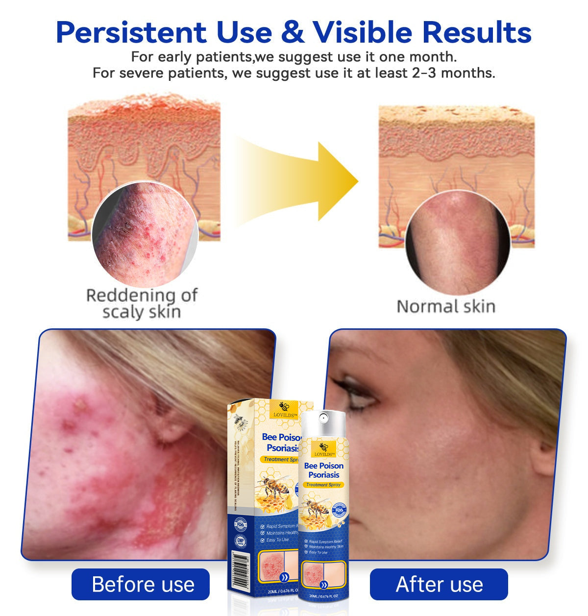 🔥رذاذ PsoriaHeal لعلاج الصدفية (خصم 60% على شراء الحزمة حتى اليوم الأخير فقط 🔥)